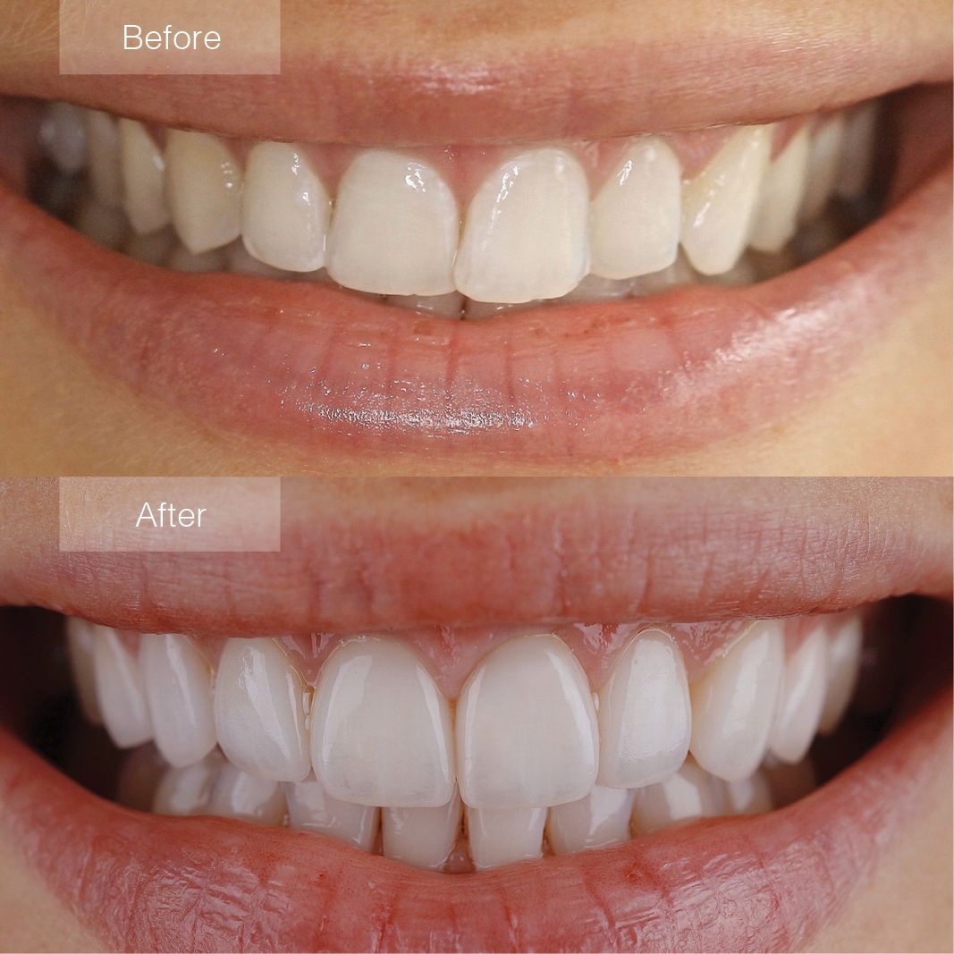 dental veneers before and after 2